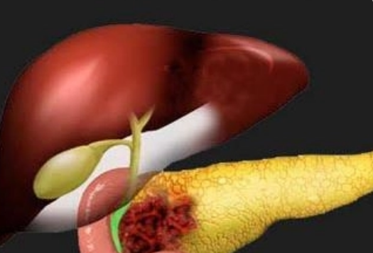 胰腺癌晚期补硒(胰腺癌补硒有什么好处)-硒宝网