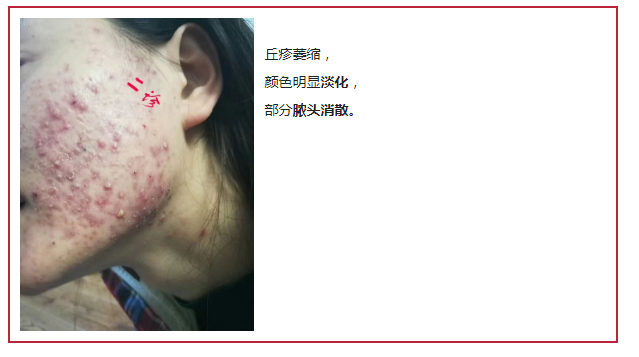 补硒治愈银屑?。ㄖ斡〔刮疾〉囊┪铮?硒宝网