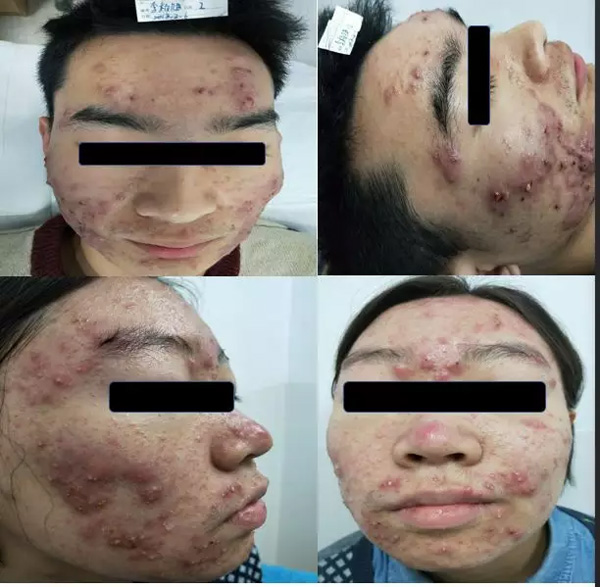 补硒治愈银屑病（治愈病补硒银屑病的药物）-硒宝网