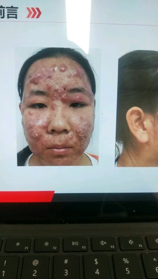 补硒治愈银屑?。ㄖ斡〔刮疾〉囊┪铮?硒宝网