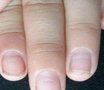 补硒溃疡结肠炎(补结肠炎溃疡硒片吃多久)-硒宝网