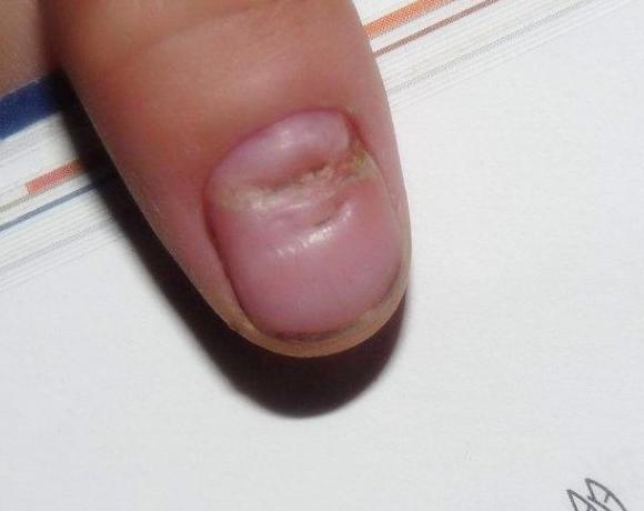 补硒溃疡结肠炎(补结肠炎溃疡硒片吃多久)-硒宝网