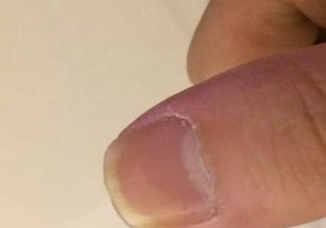 补硒溃疡结肠炎(补结肠炎溃疡硒片吃多久)-硒宝网