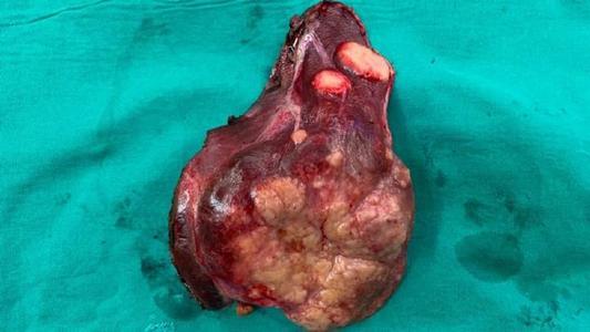 补硒肿瘤标志物(肿瘤硒)-硒宝网