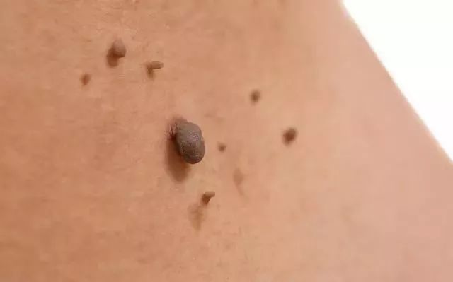 补硒会起疙瘩吗(吃硒片长痘痘)-硒宝网