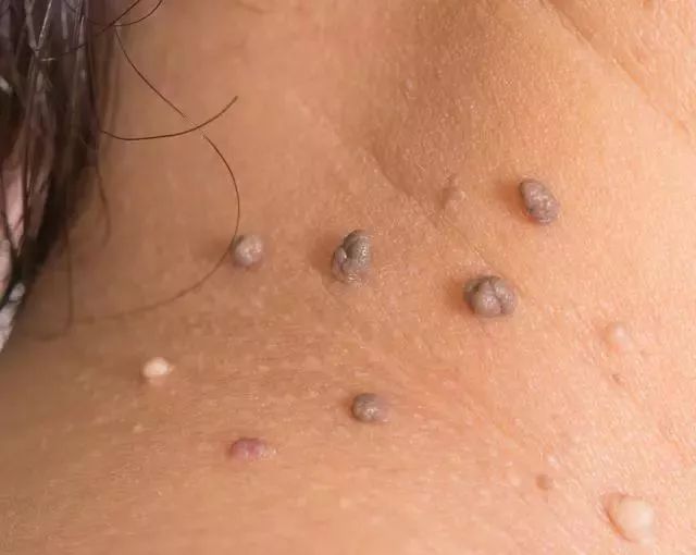 补硒会起疙瘩吗(吃硒片长痘痘)-硒宝网