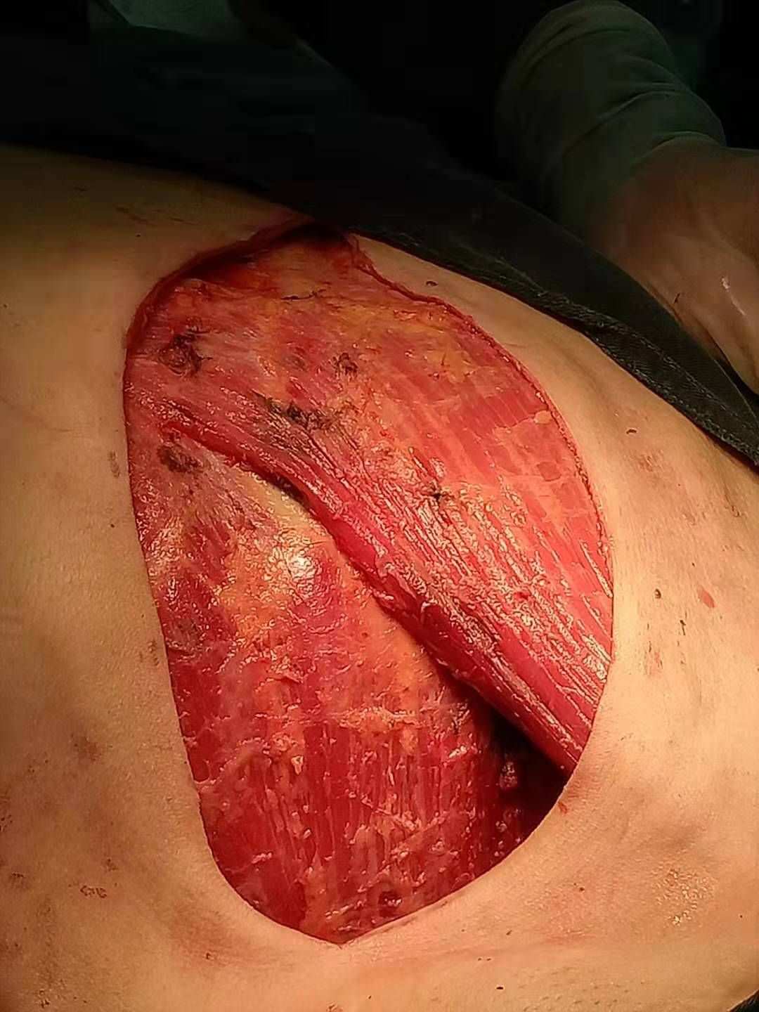 乳腺癌手术补硒(癌手术乳腺补硒吃什么好)-硒宝网