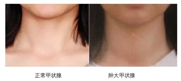 优甲乐和补硒的（优甲乐与硒有冲突吗）-硒宝网