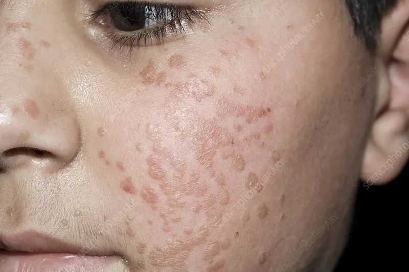 补硒能治瘊子吗(能治补硒瘊子的药物)-硒宝网