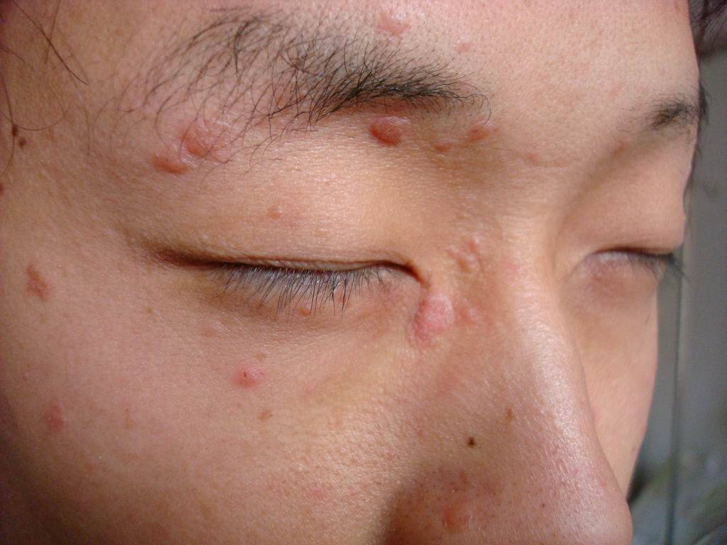 补硒能治瘊子吗（硒能治疗什么病吗）-硒宝网