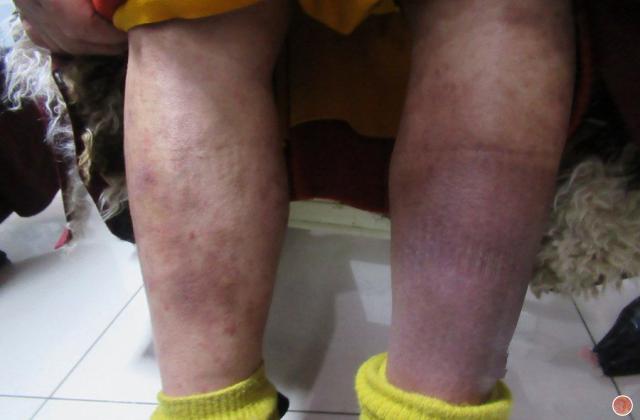 补硒治疗银屑病（补硒治疗银屑病最好）-硒宝网