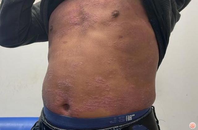 补硒治疗银屑?。ú刮瘟埔疾∽詈茫?硒宝网