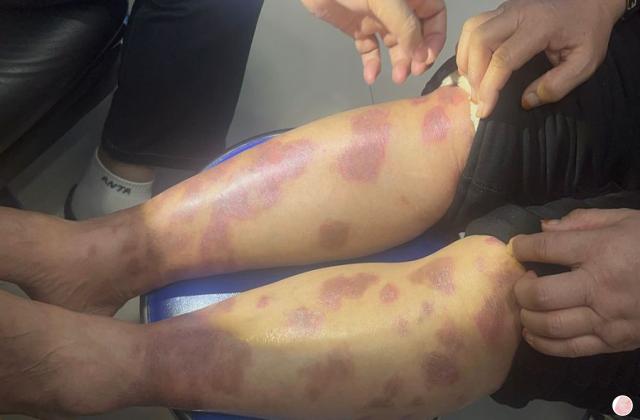 补硒治疗银屑?。ú刮瘟埔疾∽詈茫?硒宝网