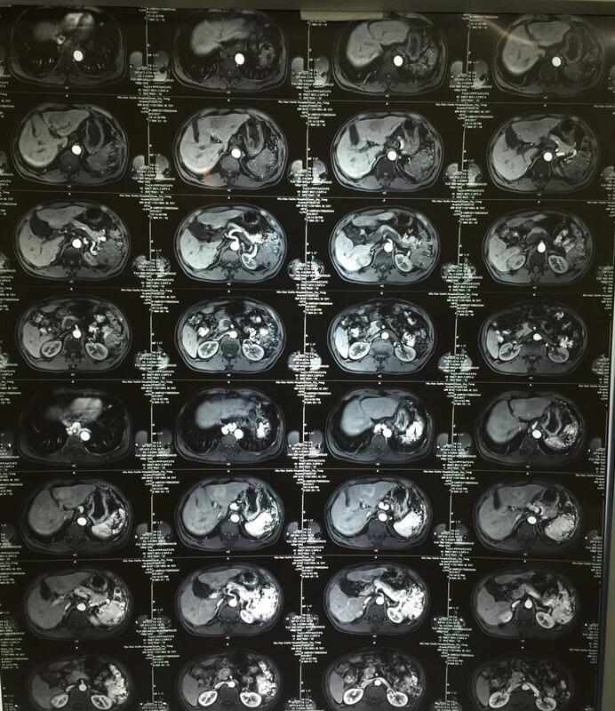 甲胎蛋白高补硒（甲胎蛋白高补硒）-硒宝网