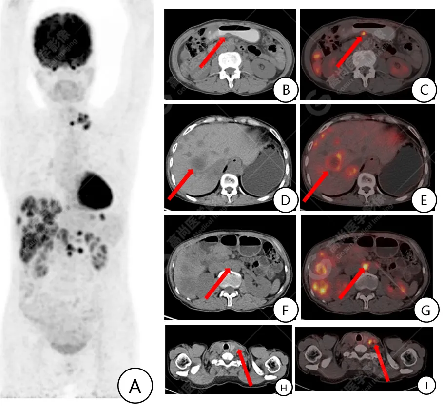 甲胎蛋白高补硒（甲胎蛋白高补硒）-硒宝网