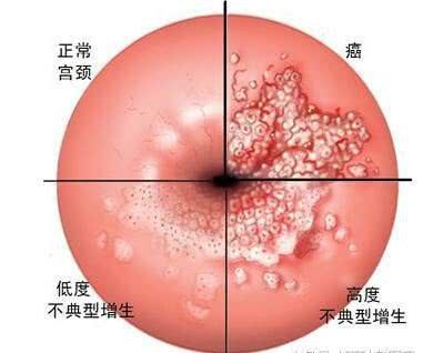宫颈癌如何补硒(宫颈癌补硒有用吗)-硒宝网