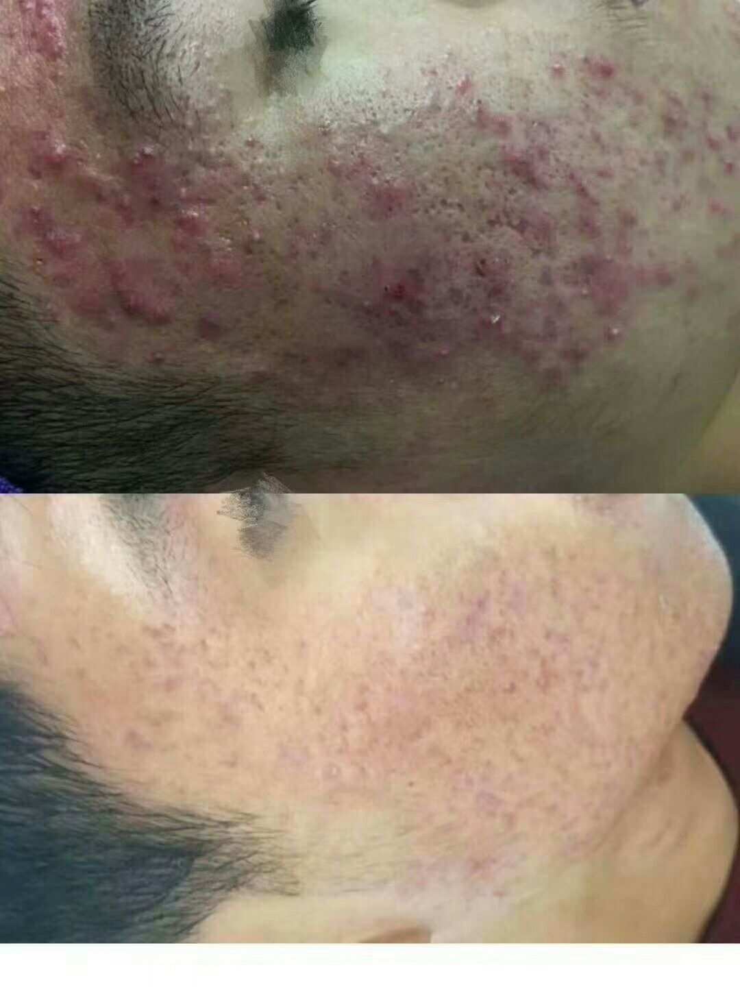 补硒会不会长痘（缺硒会长痘痘吗）-硒宝网