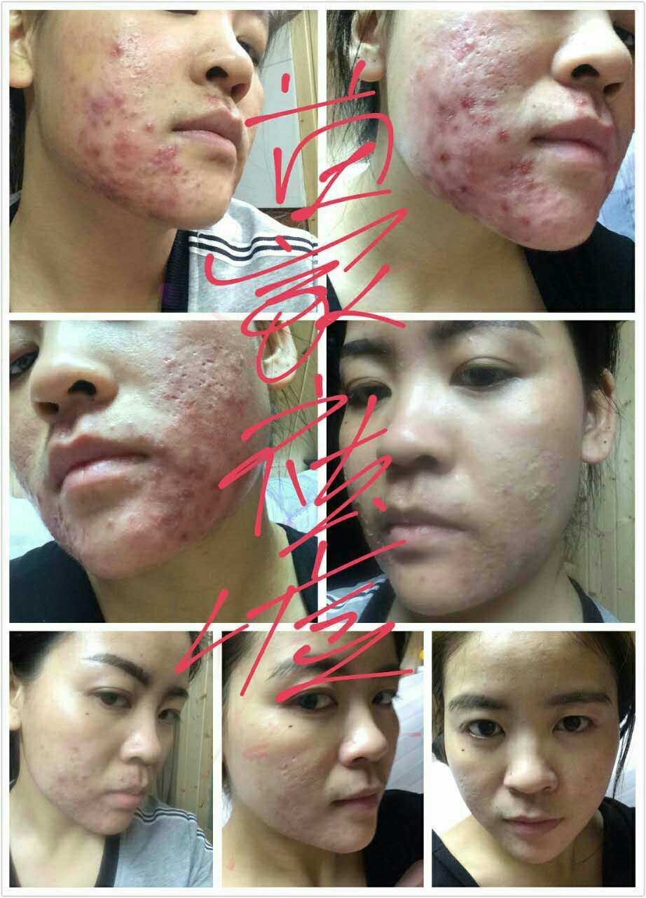 补硒会不会长痘（缺硒会长痘痘吗）-硒宝网