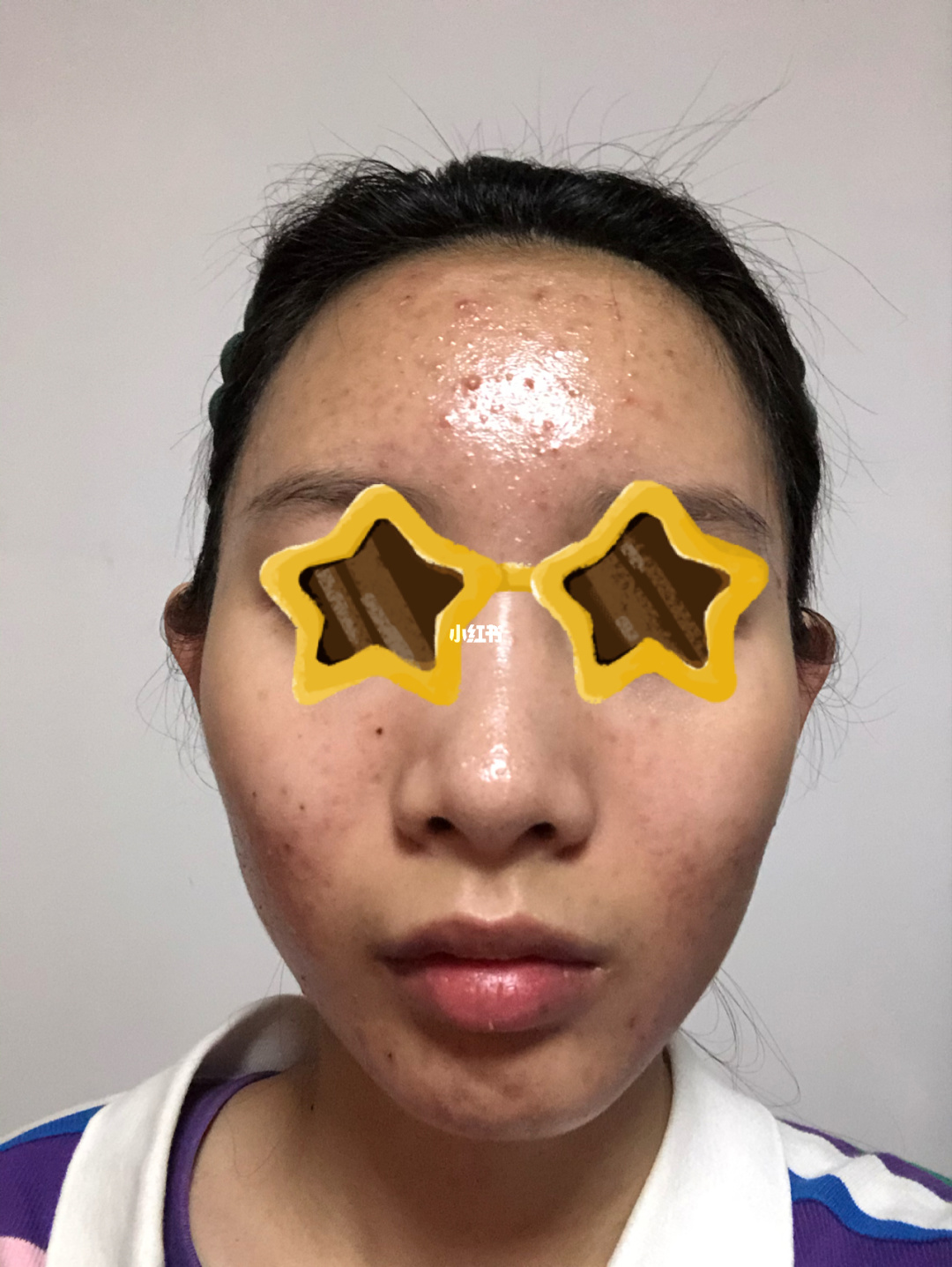 补硒会不会长痘（缺硒会长痘痘吗）-硒宝网