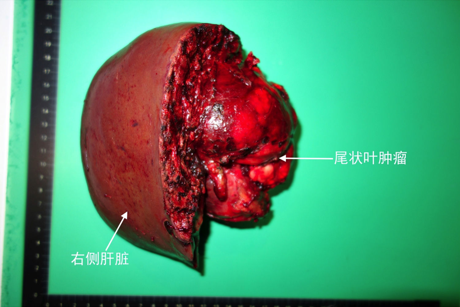 肾移植能补硒吗(肾移植能吃补锌片吗)-硒宝网