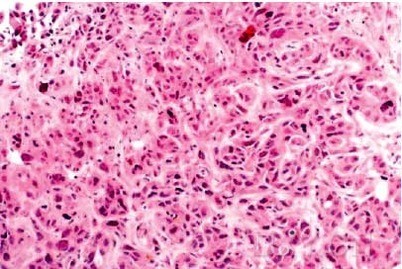 肾移植能补硒吗(肾移植能吃补锌片吗)-硒宝网