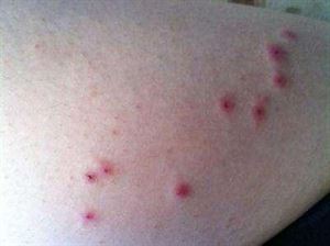 急性白血病补硒(急性白血病补硒吃什么)-硒宝网