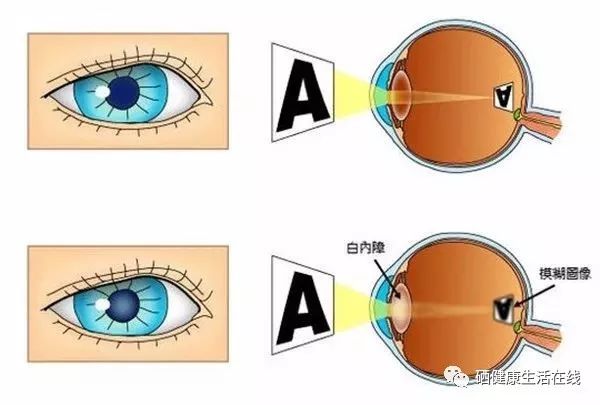 近视补硒有用吗(近视补硒用有效果吗)-硒宝网