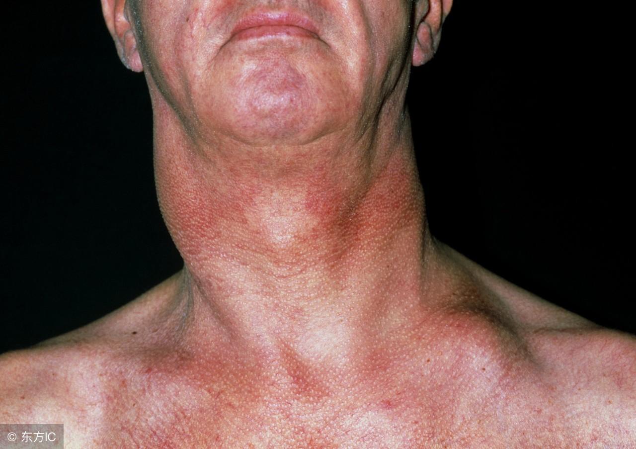 补硒淋巴结肿大（补淋巴结肿大硒片吃多久）-硒宝网