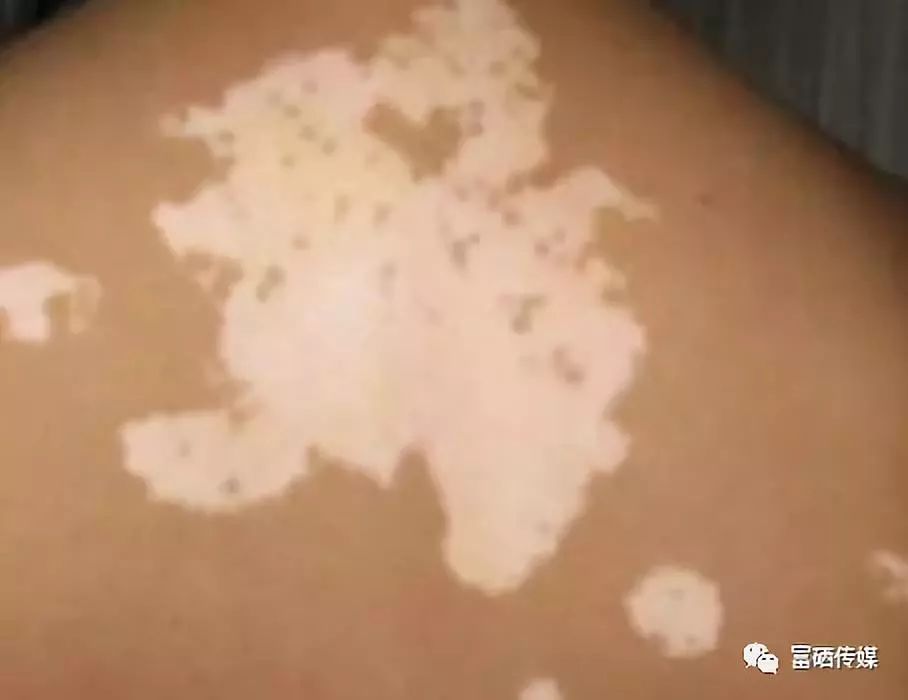 糖尿病人能补硒（病人能补糖尿硒吗）-硒宝网