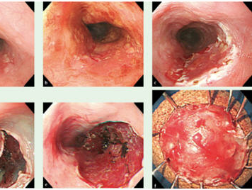 食道癌能补硒吗（癌症能补硒）-硒宝网