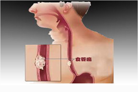 食道癌能补硒吗（癌症能补硒）-硒宝网
