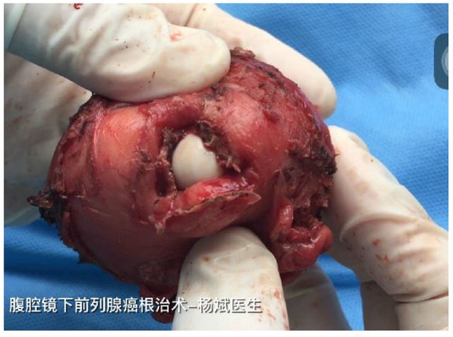 补硒与前列腺癌(前列腺补硒)-硒宝网