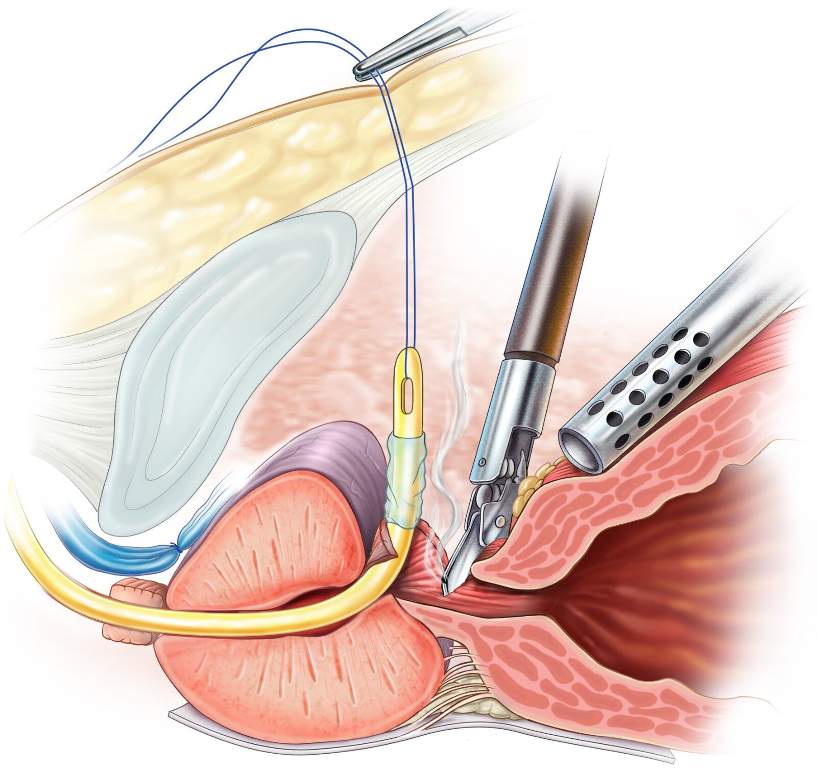补硒与前列腺癌(前列腺补硒)-硒宝网