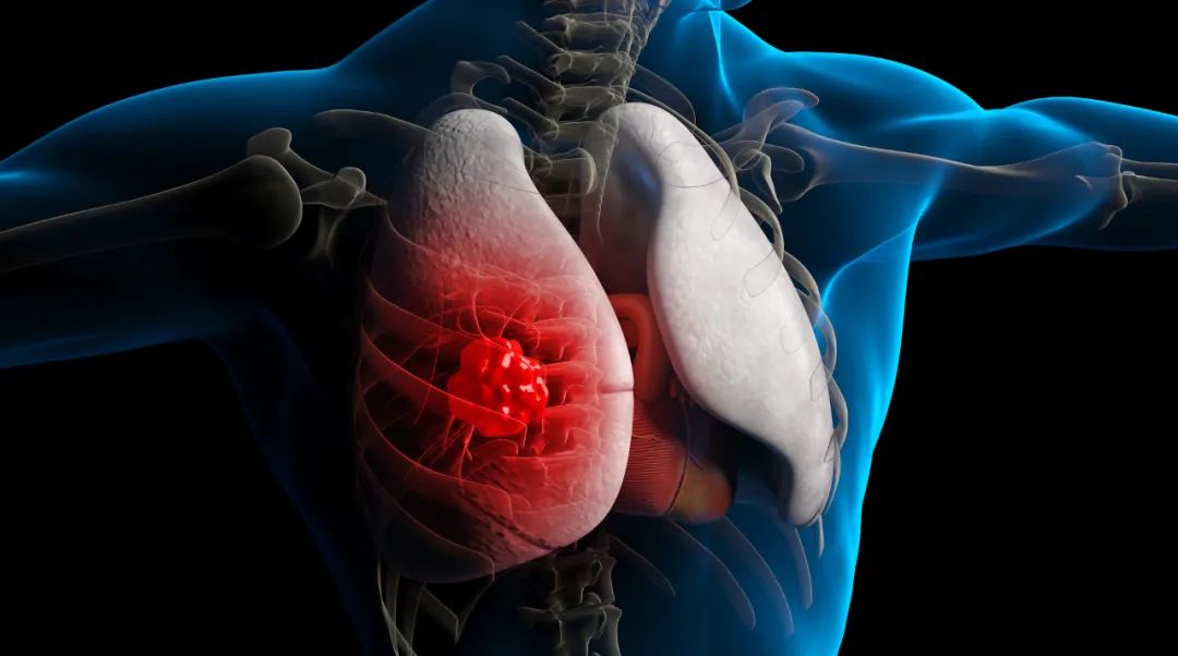 硒产品治肺结节(肺结节吃硒有用么)-硒宝网