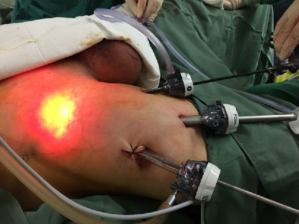 硒维康 癌术后(硒维康能抗癌吗)-硒宝网