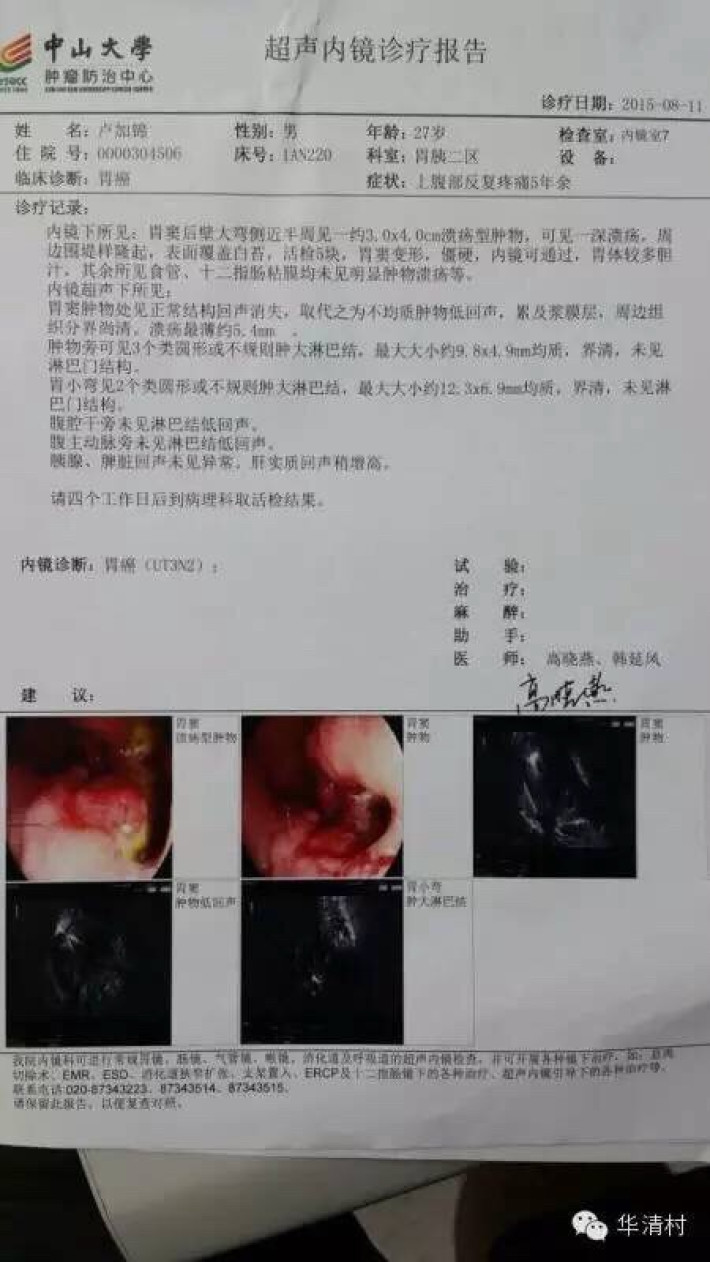 硒维康治疗胃癌（胃癌硒）-硒宝网