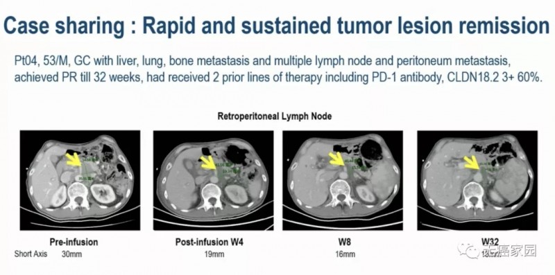 硒维康治疗胃癌（胃癌硒）-硒宝网