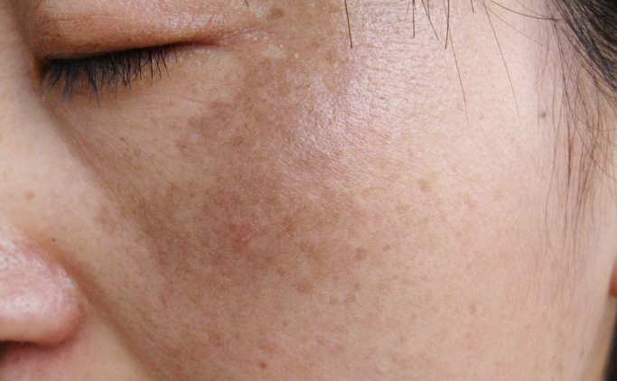 硒维康皮肤发黄（硒片对皮肤的作用）-硒宝网