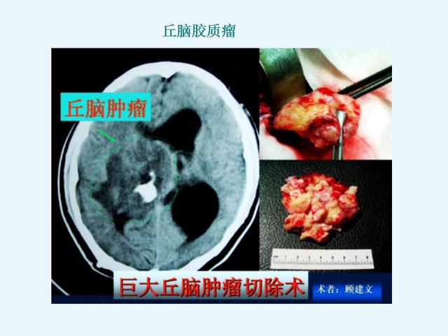 硒维康对胶质瘤(硒对脑胶质瘤有什么作用)-硒宝网