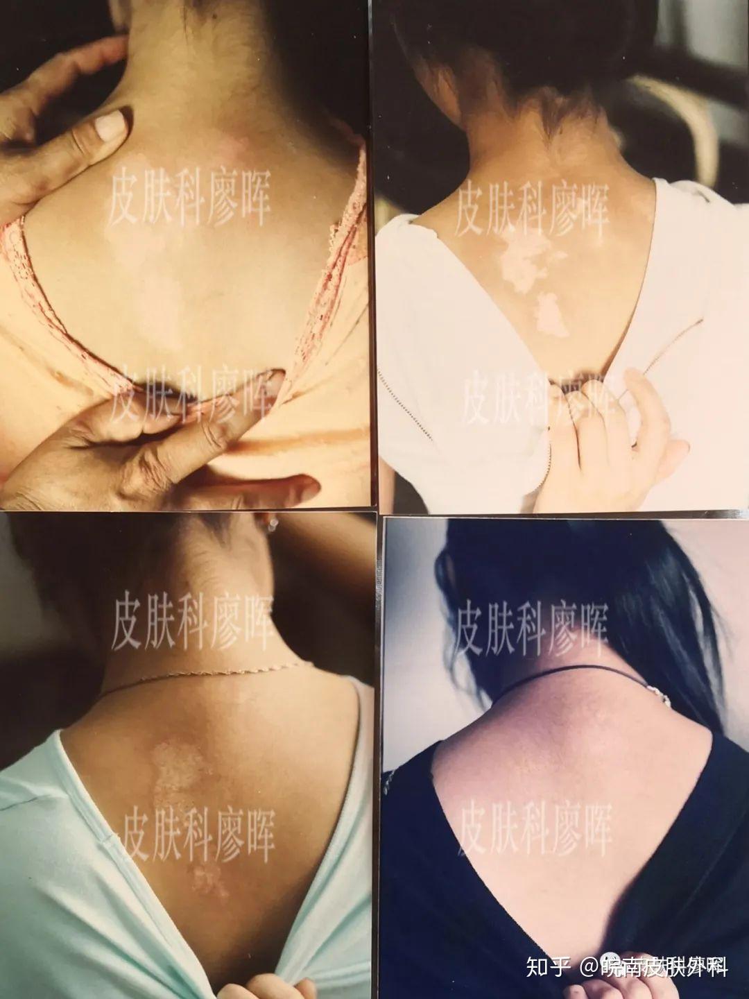 白癜风吃锌硒宝(白癜风吃锌硒宝)-硒宝网