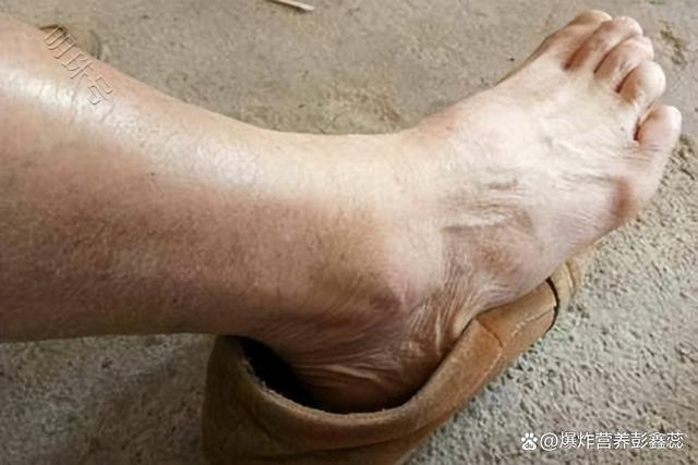 高尿酸补哪种硒(硒尿酸)-硒宝网