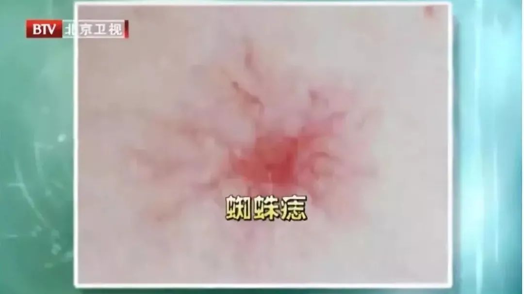 吃锌硒宝片上火（锌会不会上火）-硒宝网