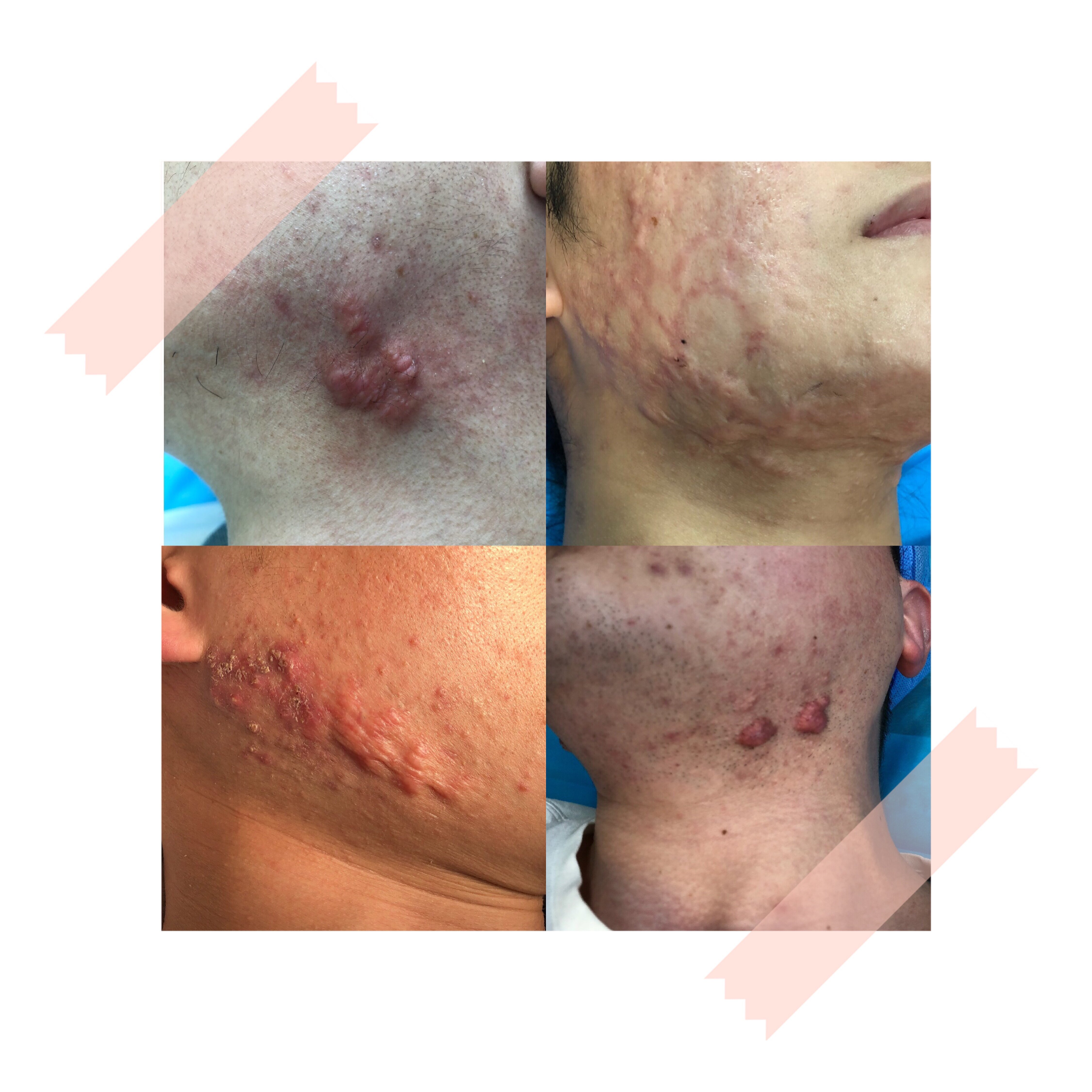 锌硒宝治疗长痘(锌对痘痘的作用)-硒宝网