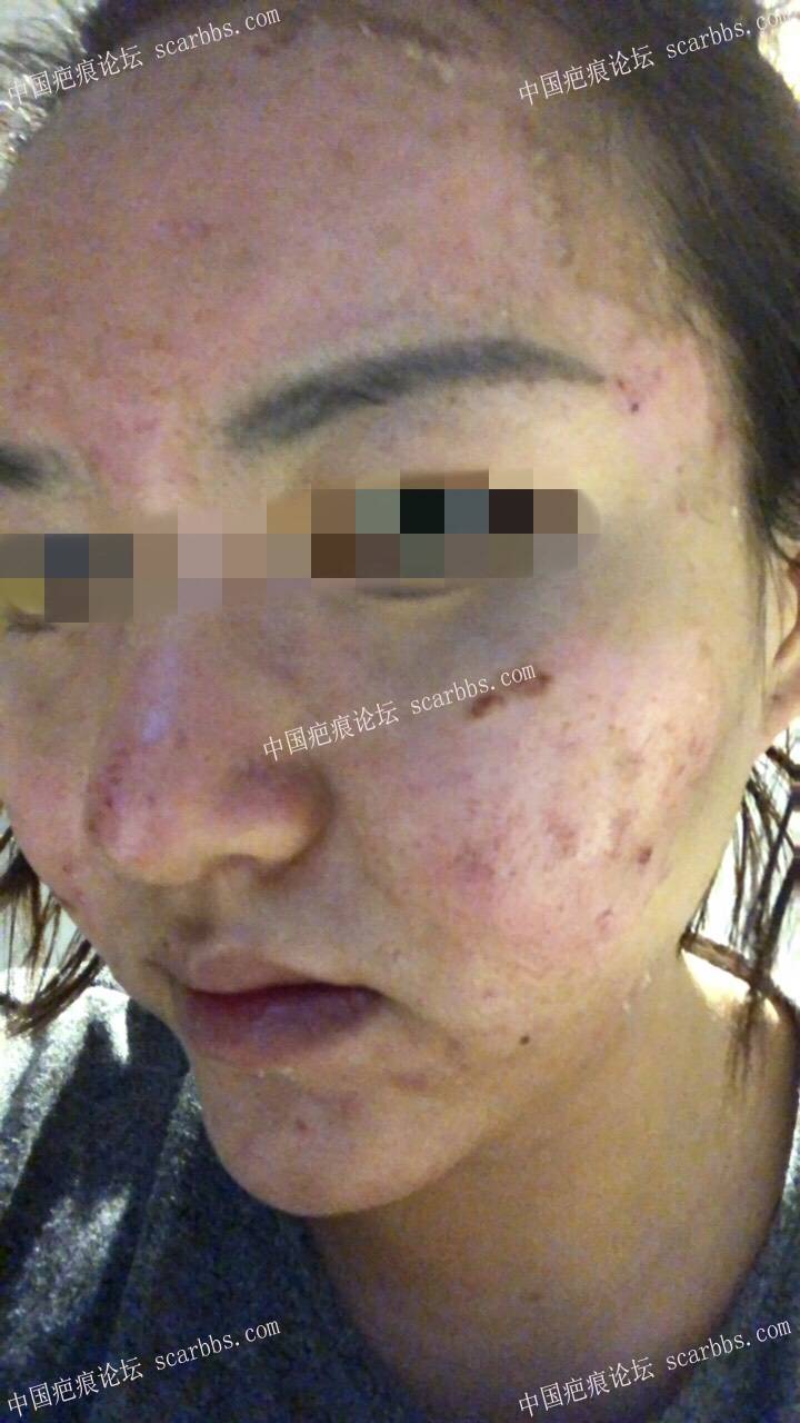 锌硒宝治疗长痘(锌对痘痘的作用)-硒宝网