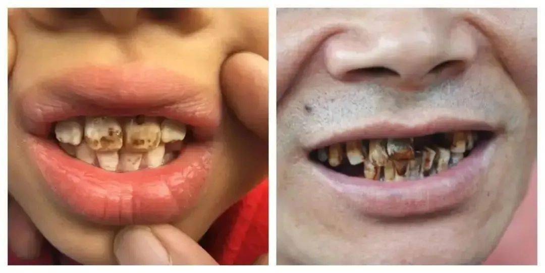 牙齿不齐补硒元素（牙齿齐补元素硒多少钱）-硒宝网