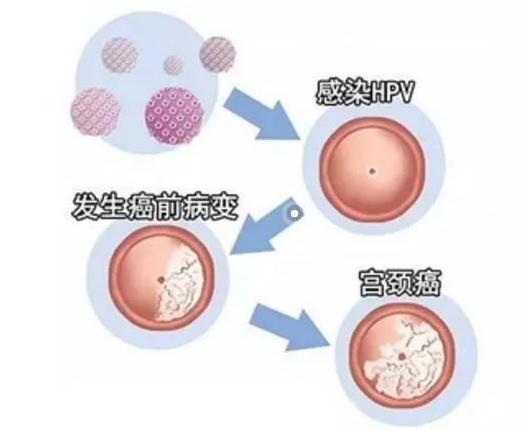 女性补硒抗hpv(hpv补硒的药物哪种最好)-硒宝网