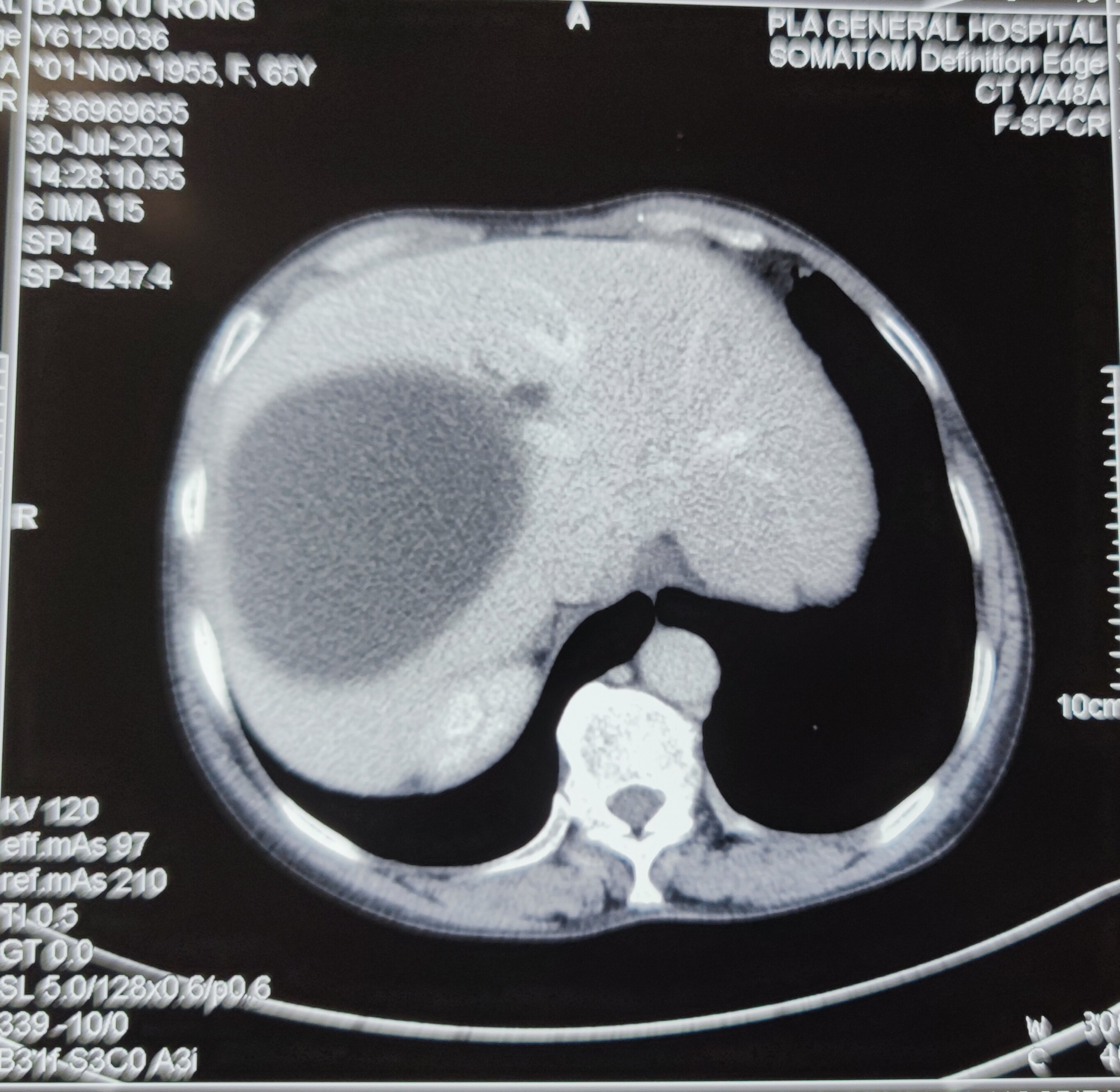 患了肺癌如何补硒(肺癌补硒)-硒宝网