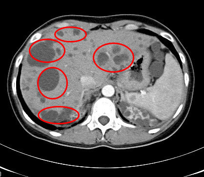 患了肺癌如何补硒(肺癌补硒)-硒宝网