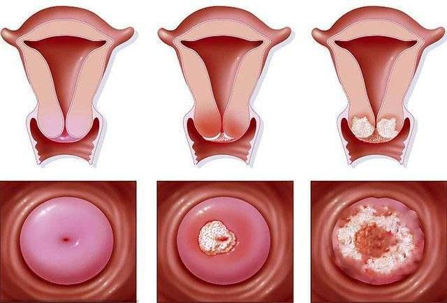 hpv高危阳补硒（hpv高危阳性吃硒片有用吗）-硒宝网