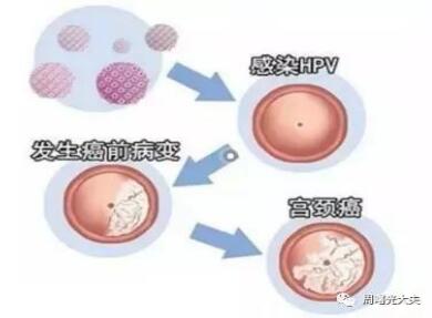 hpv高危阳补硒（hpv高危阳性吃硒片有用吗）-硒宝网